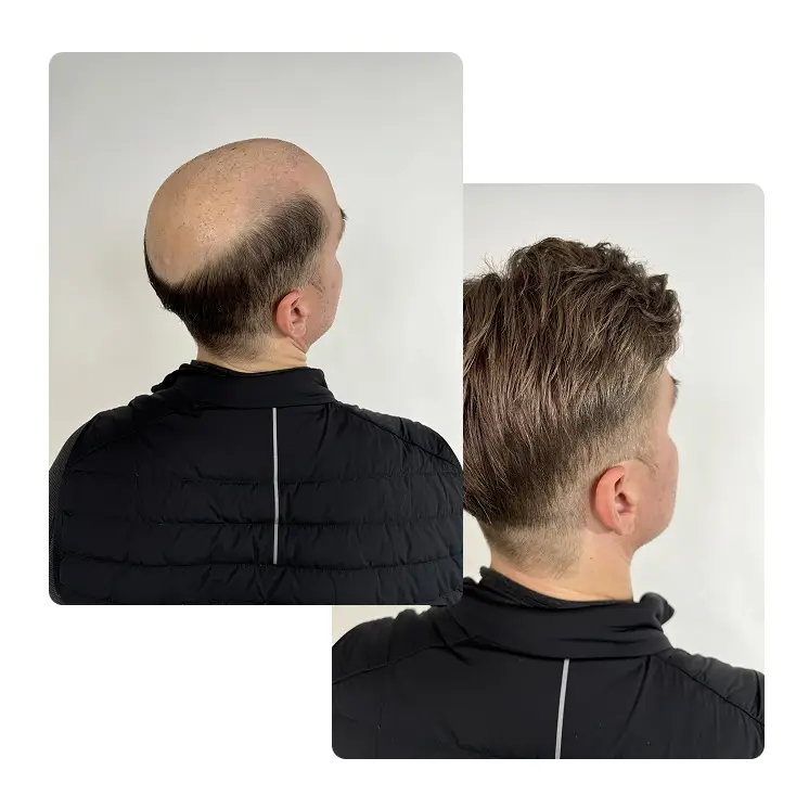 Men's Hair Replacement | Capelli Salon Dallas